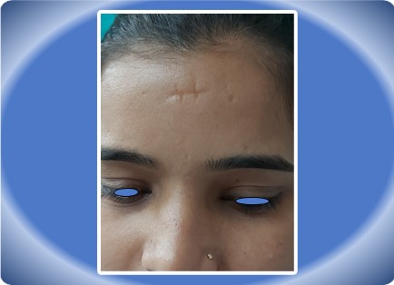 SCAR FACE